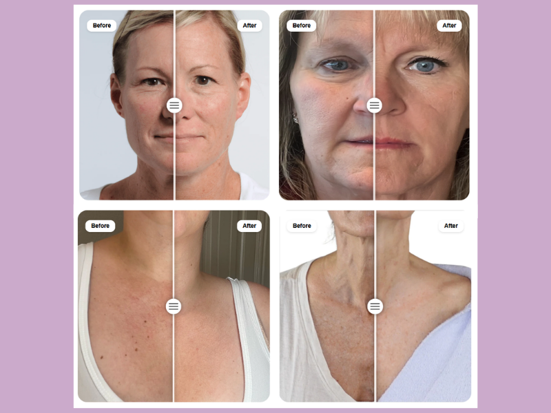 Botox fillers microneedling autoimmune skin care